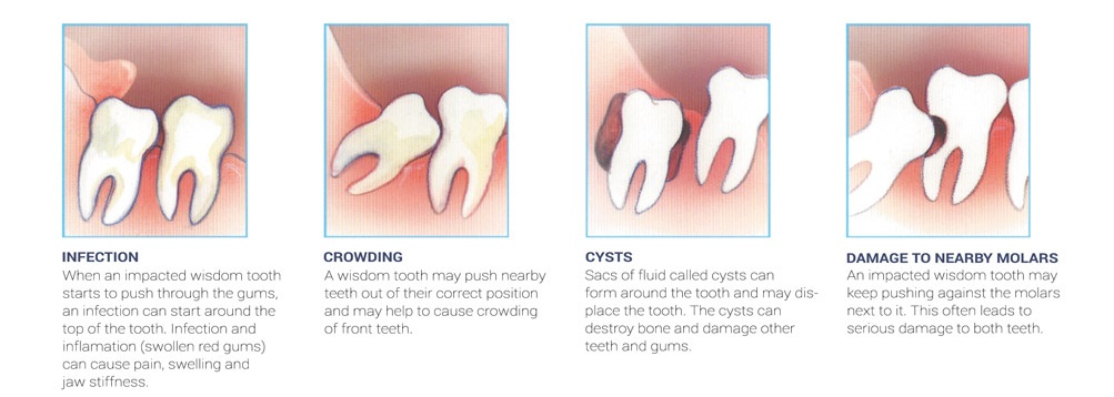impacted wisdom teeth removal